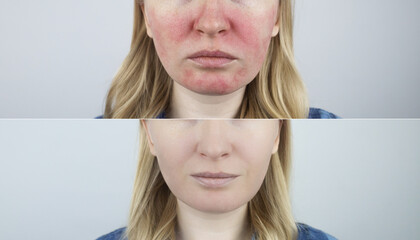Rosacea face. The girl suffers from redness on her cheeks. Couperosis of the skin. Redness and...