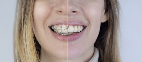 Before and after remove braces. On left is a girl in a metal bracket system, and on right are...
