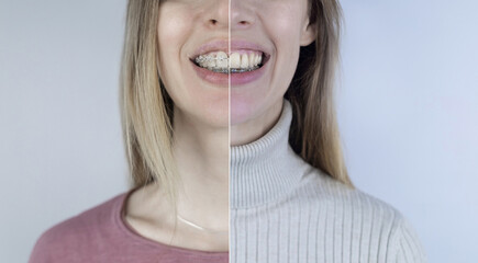 Before and after remove braces. On left is a girl in a metal bracket system, and on right are...