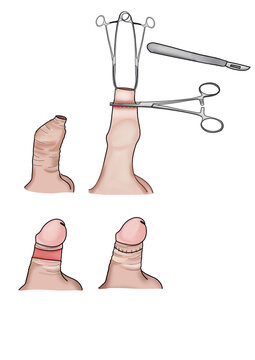 Illustration &uuml;ber eine Zirkumzision, Beschneidung 