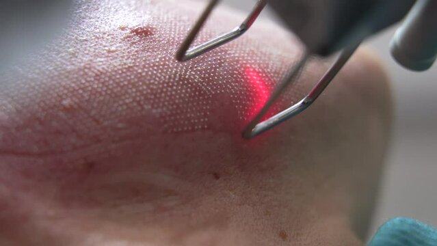 Extreme close up shot of Beautician cosmetologist doing procedure fractional microneedle mesotherapy rejuvenation with laser technology. Hardware cosmetology in clinic salon for client.