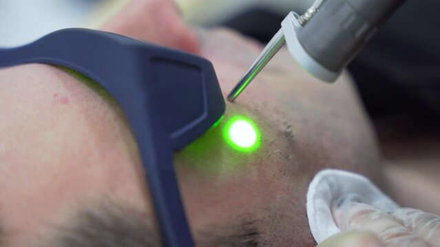 Man face epilation laser hair removal procedure treatment with alexandrite laser, unpainful procedure, beauty concept,