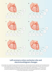 When different parts of the left coronary artery are occluded, it can lead to ST segment elevation or depression in different chest leads on the electrocardiogram.