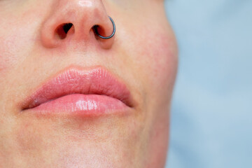 close-up detail of a woman's lips recently injected with botulinum toxin