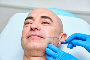 marking the face of a man with a dermographic pencil for treatment with botulinum toxin of bruxism