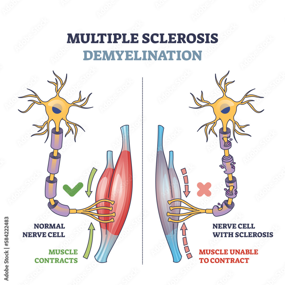 Wall mural Multiple sclerosis demyelination compared with medical healthy nerves outline diagram. Labeled educational scheme with anatomical and medical autoimmune disease muscle contraction vector illustration