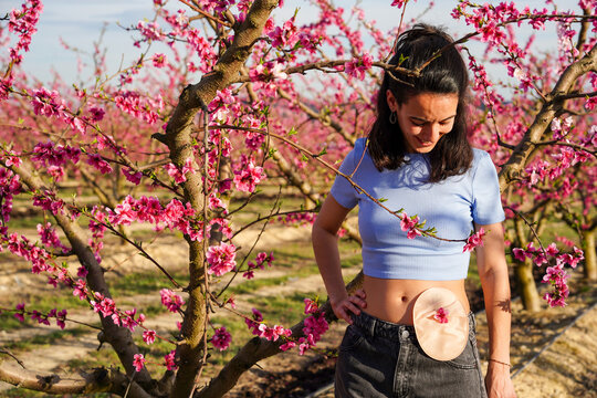 woman in a field of pink flowers looking at the colostomy bag in spring. colon cancer day
