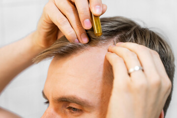 Middle aged caucasian white man uses, applies to hair with cosmetic ampoules with serum for hair growth, restoration beauty hair. The concept of the problem of male hair loss, baldness and alopecia