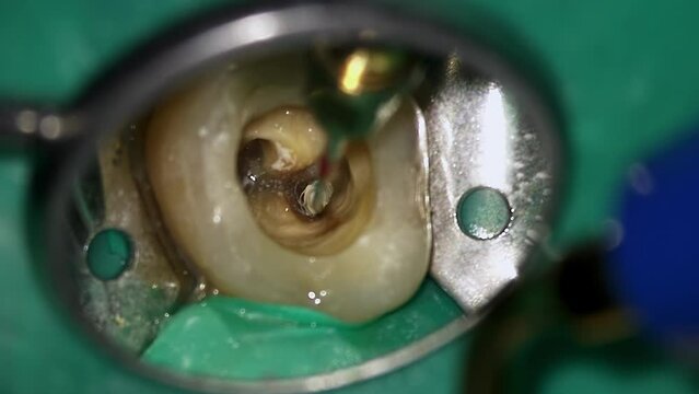 Macro footage of tooth with huge hole decayed by caries and dentist treating it with drill. Doctor restores aching teeth using mirror and professional medical equipment in oral cavity. Health problems