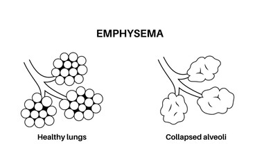 Emphysema anatomical poster