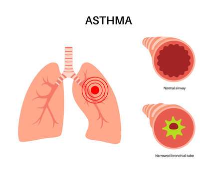 Asthma lung disease