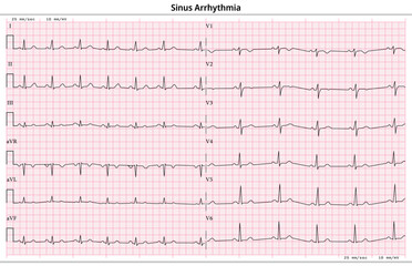 ECG Sinus Arrhythmia - 12 Lead ECG Common Case - 6 Sec/lead - Vector Illustration