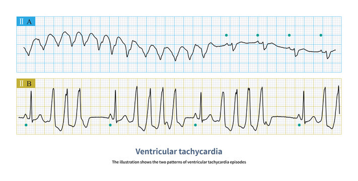 The illustration shows the two patterns of VT episodes.The green circle represents sinus rhythm. Picture A shows paroxysmal episodes of VT a, and picture B shows short bursts.