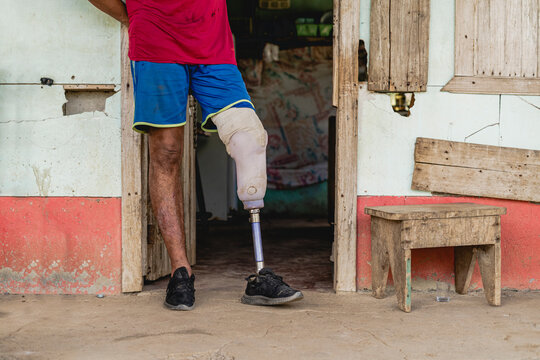 Legs of an amputated man. 