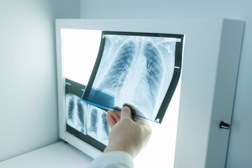 doctor studying x-ray on computer