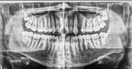 Dental panoramic radiograph with tooth gemination in the lower wisdom tooth number 48. Dental phenomenon that appears to be two teeth developed from one. French text meaning "right".