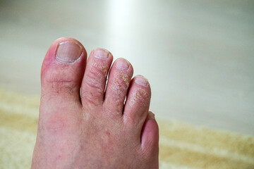 neglected toes, fungus and calluses on the fingers, close-up calloused toes,