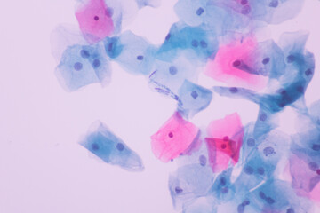 View in microscopic of Candidiasis, fungus infection (Yeast and Pseudohyphae form) in pap smear slide cytology and diagnostic by pathologist.Gynecology report and diagnosis.Sexually transmitted.