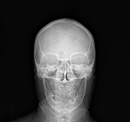 X-ray of a human skull, direct posterior view