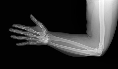 X-ray image of the elbow joint, without visible traumatic and bone-destructive changes.