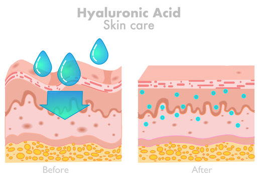 Hyaluronic Acid, Skin Care. Before After Products. HA Absorb, Rejuvenation Wrinkles. Human Facial Fillers. Water Moisturizer. Dermatology, Humectant, Skincare, Anti Aging. Illustration Vector