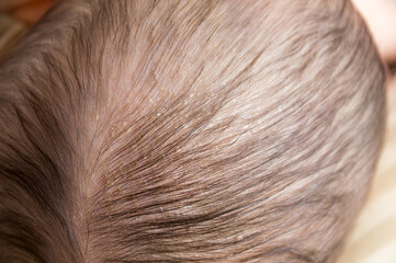 Newborn baby with psoriasis or dandruff in the hair