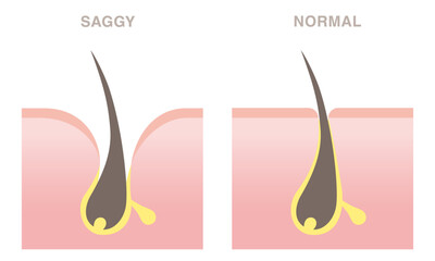 Skin cross section of pore types. Normal pore and saggy pore. Pale colored illustration in flat cartoon style.