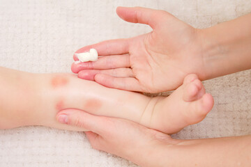 Toddler baby skin care, allergies and dermatitis. A mother woman smears red spots of allergy and atopic dermatitis on the child skin with cream. Kid aged one year eight months