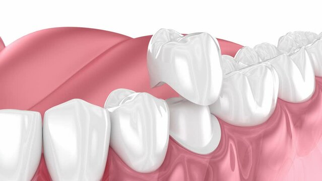Preparated premolar tooth and dental crown placement. Dental 3D animation