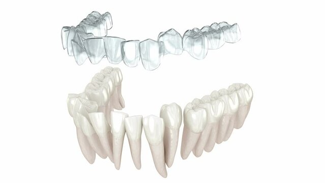 Invisalign braces or invisible retainer make bite correction. 3D animation