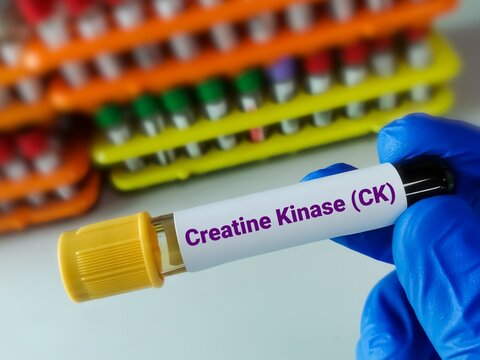 Scientist holding blood sample for Creatinine Kinase (CK). Creatinine Phosphokinase (CPK) test. Myositis.