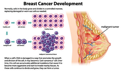 Cancer Development vector with information