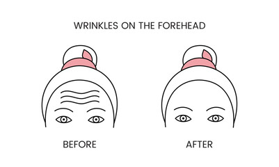 Wrinkles on the forehead, laser cosmetology before procedure and after applying treatment line icon in vector. Illustration of a woman with smooth clean skin and problematic skin.