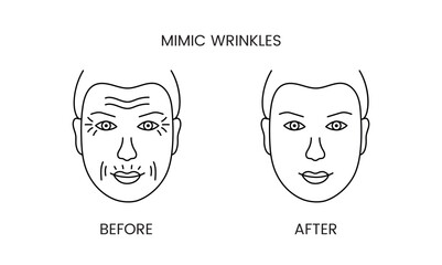 Mimic wrinkles, laser cosmetology before procedure and after applying treatment line icon in vector. Illustration of a man with smooth clean skin and wrinkles