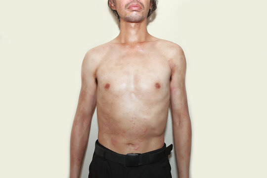 Skin diseases caused by psoriasis and the immune system