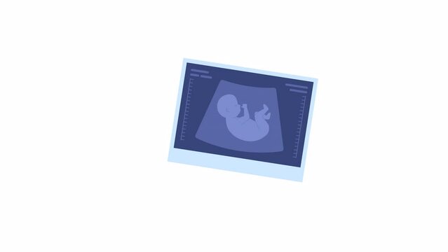Animated ultrasound picture. Sonogram photo. First pregnancy announcement. Flat cartoon style icon 4K video footage. Color isolated object animation on white background with alpha channel transparency