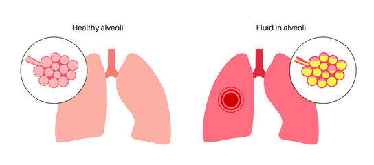 Pneumonia infection poster