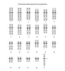 Chromosome Monosomy X Turner Syndrome
