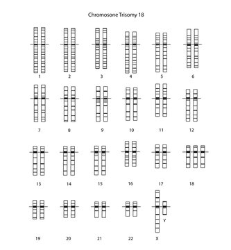 Chromosome Trisomy 18