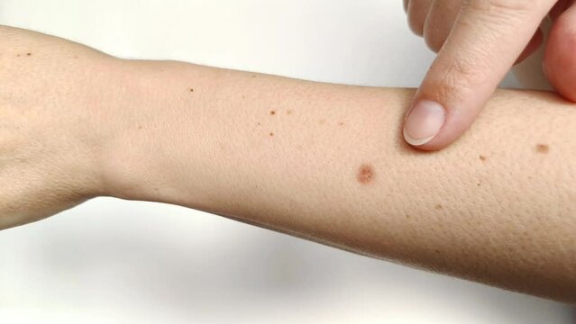 Birthmark brown spot on the arm. Benign formation on the skin. 