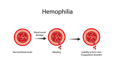 Hemophilia, a bleeding disorder that slows the blood clotting. Haemophilia (Coagulation disorder). Damaged blood vessel, hemorrhage. Healthy blood vessel after bleeding. Vector illustration.