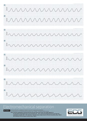 Electromechanical separation is a kind of terminal ECG. The patient's ECG has electrical signals, the ECG wave is widened with morphological abnormalities, and the ventricle has no contraction.