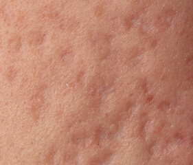 Fototapeta premium Acne scars on the skin. Macro.