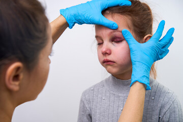Doctor checking girl eye with bruise, close-up