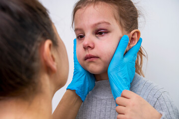 Doctor checking girl eye with bruise, close-up