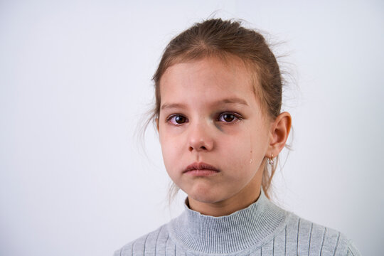 Portrait of a child girl with facial hematoma, close-up