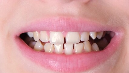 Child girl or teenage girl of eleven years old showing her teeth to the dentist. Concept of orthodontics, dental health, braces