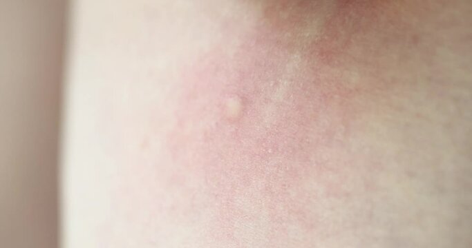 Hand scratching itchy skin rash after mosquito bite closeup 4k movie slow motion. Diagnosis and treatment of allergic diseases concept