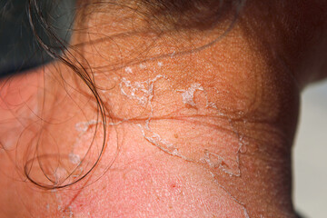 Fototapeta premium Peeling skin on the neck after sunburn . Consequences sun tan