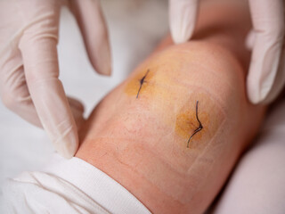 The nurse's gloved hands probe the knee joint with medical stitches after arthroscopy